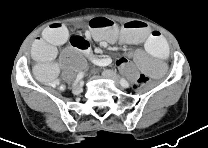 File:Acute small bowel (ileal) volvulus (Radiopaedia 71740-82139 Axial C+ portal venous phase 142).jpg