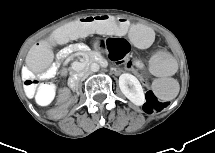 Acute small bowel (ileal) volvulus (Radiopaedia 71740-82139 Axial C+ portal venous phase 96).jpg