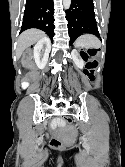Acute small bowel (ileal) volvulus (Radiopaedia 71740-82139 Coronal C+ portal venous phase 85).jpg
