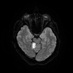 Acute superior cerebellar artery territory infarct (Radiopaedia 84104-99358 Axial DWI 21).jpg