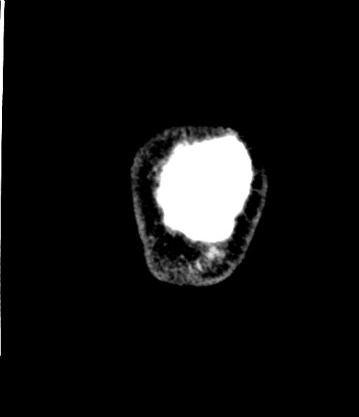 File:Acute superior cerebellar artery territory infarct (Radiopaedia 84104-99359 Coronal non-contrast 86).jpg