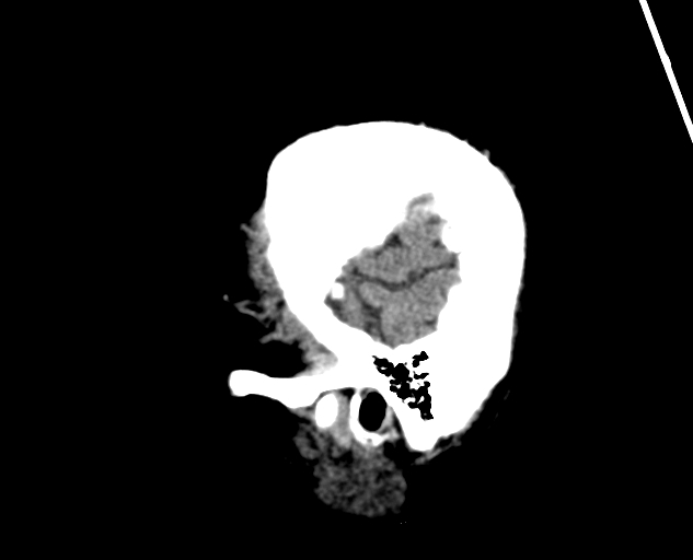 Acute traumatic subdural hematoma (Radiopaedia 82921-97257 Sagittal non-contrast 64).jpg