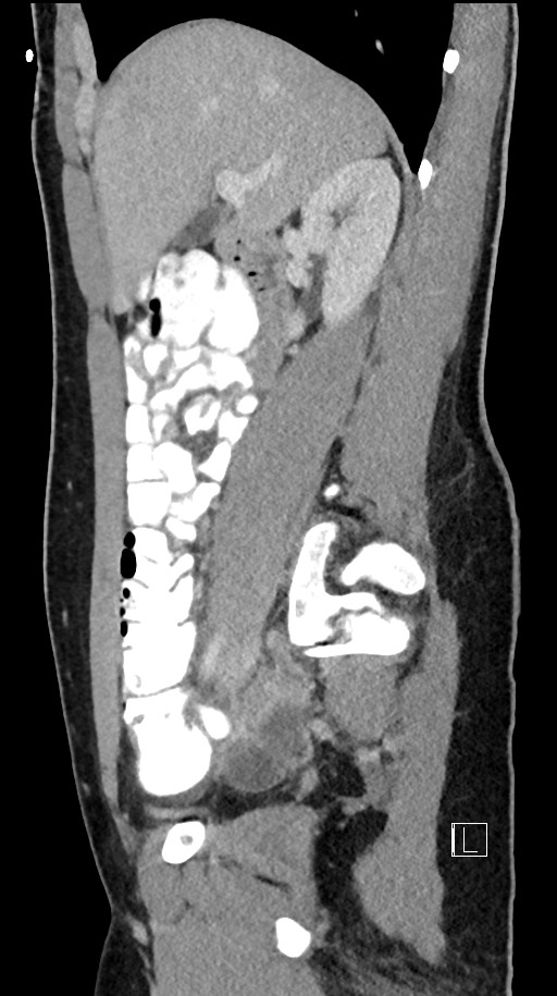 Acute uncomplicated appendicitis (Radiopaedia 61374-69304 Sagittal C+ portal venous phase 67).jpg