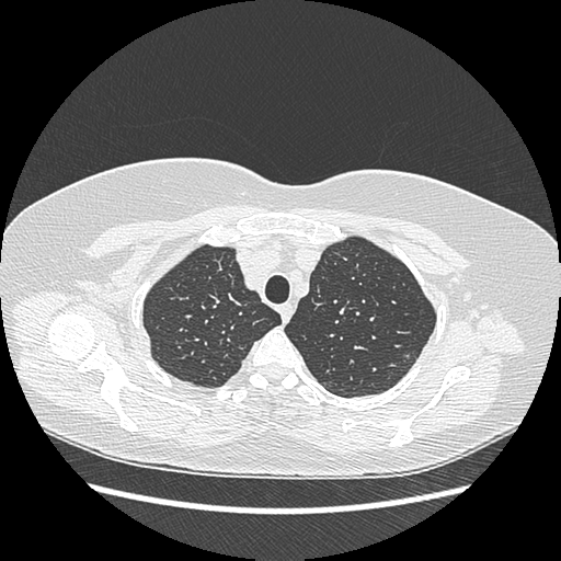 Adenocarcinoma in situ of lung (Radiopaedia 38685-40829 B 43).png