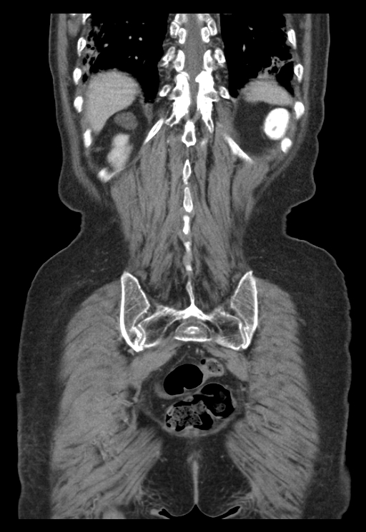 Adenocarcinoma of cecum (Radiopaedia 59222-66549 Coronal C+ portal venous phase 60).jpg
