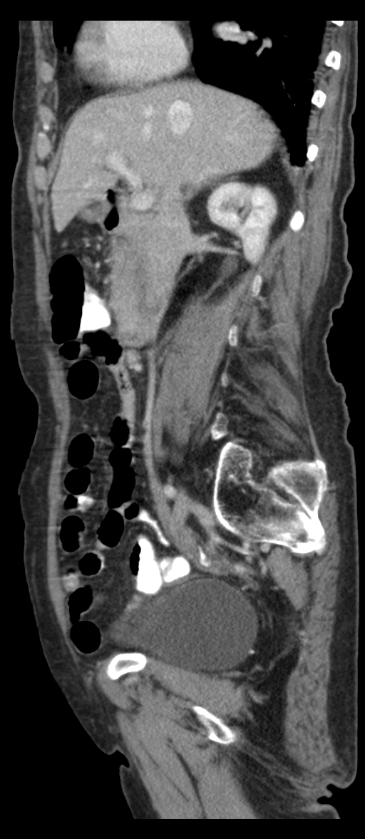 Adenocarcinoma of cecum (Radiopaedia 59222-66549 Sagittal C+ portal venous phase 61).jpg
