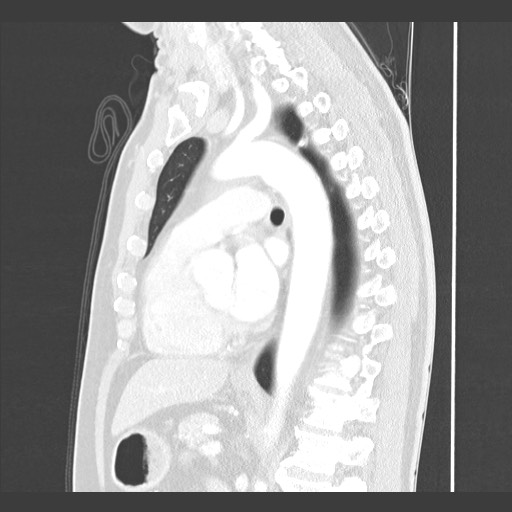 Adenocarcinoma of the lung (Radiopaedia 59871-67325 Sagittal lung window 58).jpg