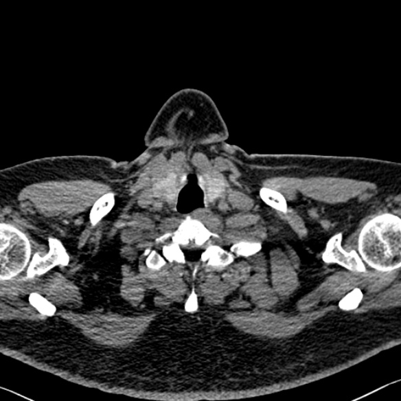 Adenoid cystic carcinoma of the trachea (Radiopaedia 49042-54137 Axial non-contrast 2).jpg