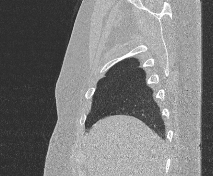 File:Adenoid cystic carcinoma of the trachea (Radiopaedia 49042-54137 Sagittal lung window 62).jpg