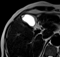File:Adenomyomatosis of the gallbladder (Radiopaedia 14447-14386 Axial T2 1).jpg