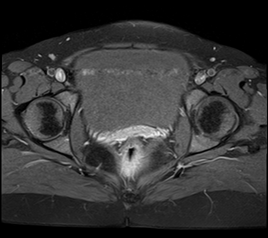 File:Adenomyosis - ovarian endometriomas (Radiopaedia 67031-76350 Axial T1 C+ fat sat 21).jpg