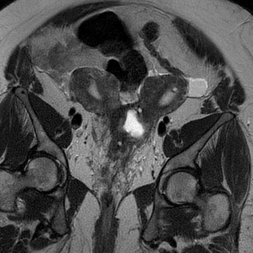 File:Adenomyosis within a didelphys uterus (Radiopaedia 70175-80215 Coronal T2 16).jpg