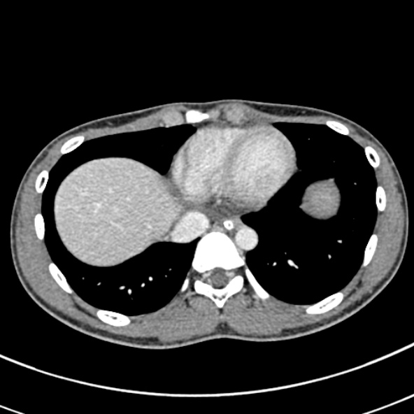 File:Adhesional small bowel obstruction (Radiopaedia 52107-57980 Axial C+ portal venous phase 6).jpg