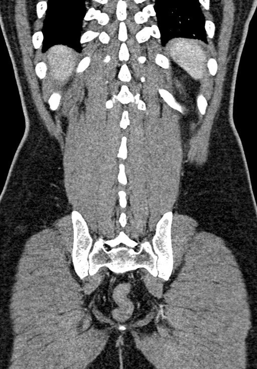 Adhesional small bowel obstruction (Radiopaedia 58900-66131 Coronal C+ portal venous phase 206).jpg