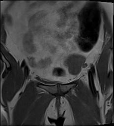 File:Adnexal multilocular cyst (O-RADS US 3- O-RADS MRI 3) (Radiopaedia 87426-103754 Coronal 8).jpg