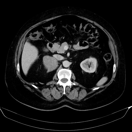 Adrenal cortical carcinoma (Radiopaedia 64017-72769 Axial C+ portal venous phase 25).jpg
