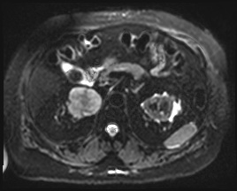 File:Adrenal cortical carcinoma (Radiopaedia 64017-72770 Axial DWI 18).jpg