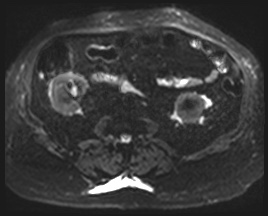 Adrenal cortical carcinoma (Radiopaedia 64017-72770 Axial DWI 34).jpg