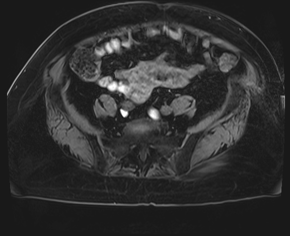 Adrenal cortical carcinoma (Radiopaedia 64017-72770 Axial T1 C+ fat sat 69).jpg