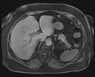 Adrenal cortical carcinoma (Radiopaedia 64017-72770 Axial T1 fat sat 19).jpg