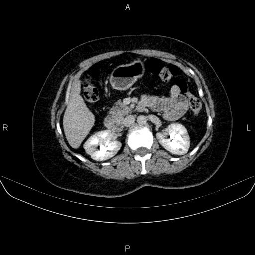 Adrenal cortical carcinoma (Radiopaedia 84882-100379 Axial C+ delayed 33).jpg