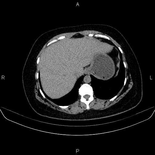 File:Adrenal cortical carcinoma (Radiopaedia 84882-100379 Axial non-contrast 14).jpg