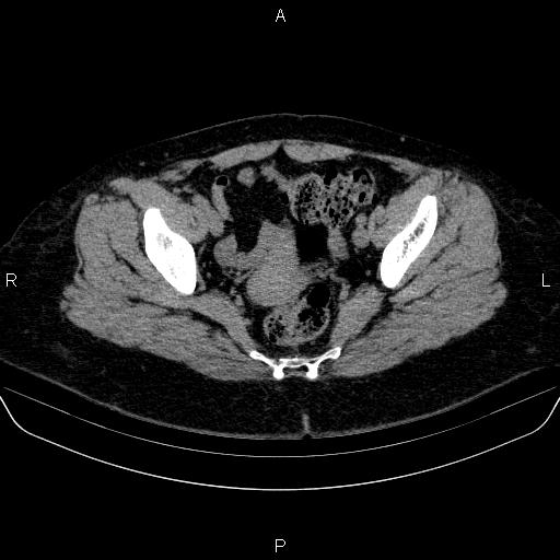 File:Adrenal cortical carcinoma (Radiopaedia 84882-100379 Axial non-contrast 84).jpg