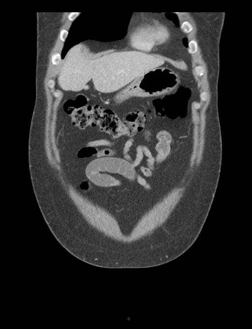 Adrenal cyst (Radiopaedia 45625-49777 Coronal C+ portal venous phase 16).png