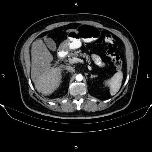 Adrenal hemorrhage (Radiopaedia 62622-70916 Axial C+ arterial phase 128).jpg