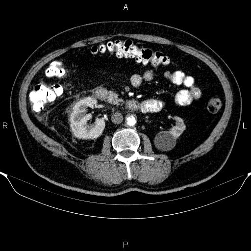 Adrenal hemorrhage (Radiopaedia 62622-70916 Axial C+ arterial phase 184).jpg