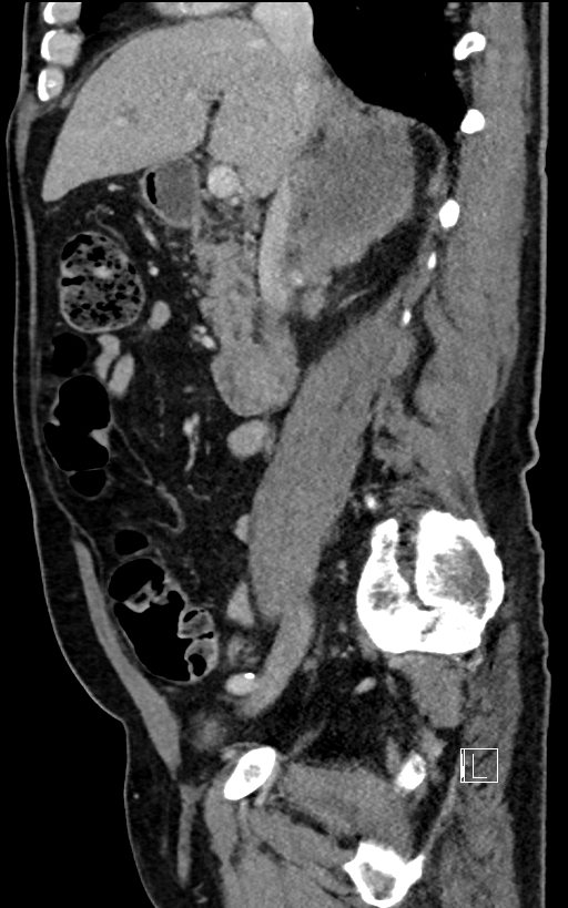 Adrenal lymphoma (Radiopaedia 73730-84529 Sagittal C+ portal venous phase 46).jpg