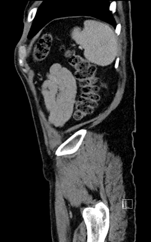 Adrenal lymphoma (Radiopaedia 73730-84529 Sagittal C+ portal venous phase 98).jpg