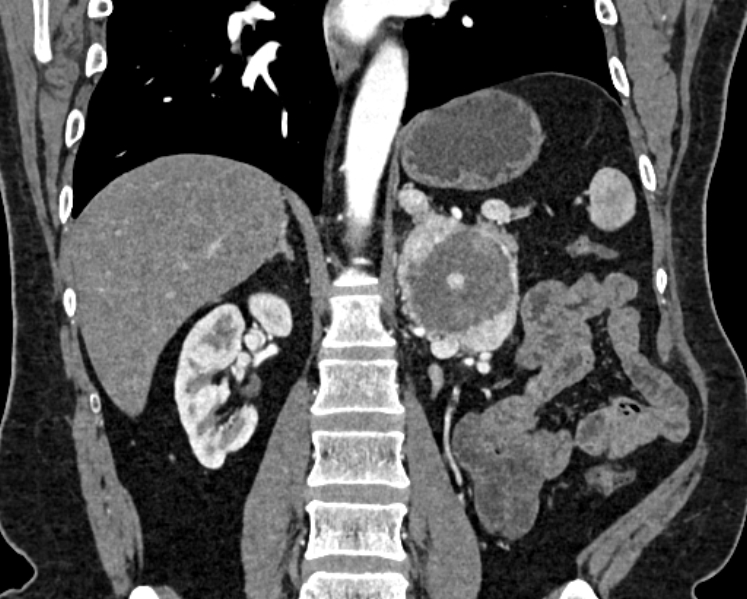 File:Adrenal metastases (Radiopaedia 73082-83791 Coronal C+ arterial phase 41).jpg