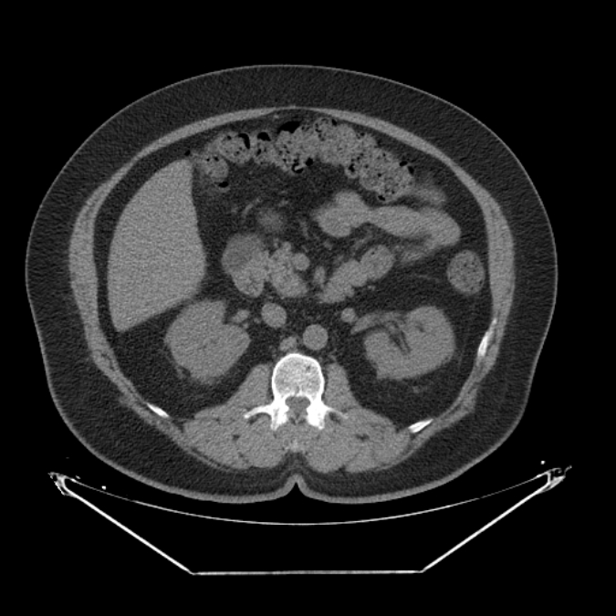 Adrenal myelolipoma (Radiopaedia 26278-26407 Axial non-contrast 26).jpg