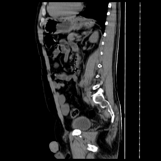 File:Adrenal myelolipoma (Radiopaedia 41843-44834 Sagittal non-contrast 25).jpg