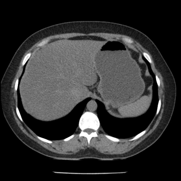 Adrenal myelolipoma (Radiopaedia 43401-46759 Axial non-contrast 15).jpg