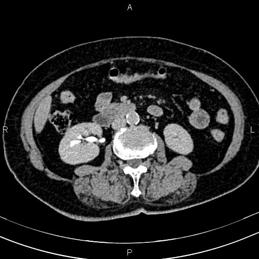 Adrenal myelolipoma (Radiopaedia 82742-96986 Axial renal excretory phase 74).jpg