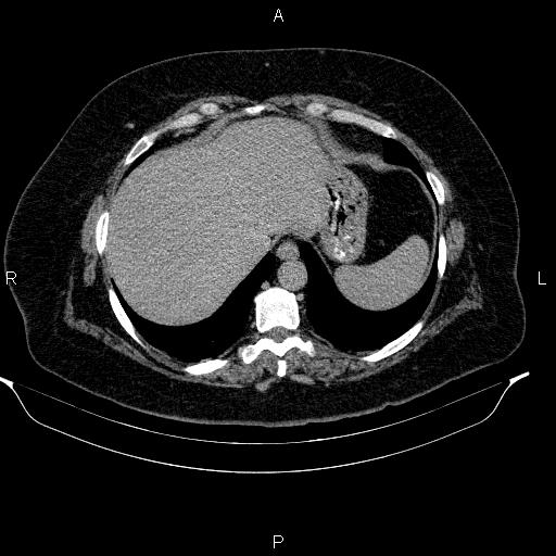File:Adrenal myelolipoma (Radiopaedia 84319-99617 Axial C+ delayed 17).jpg