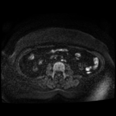 File:Adrenal myelolipoma - MRI (Radiopaedia 83249-97646 Axial DWI 25).jpg