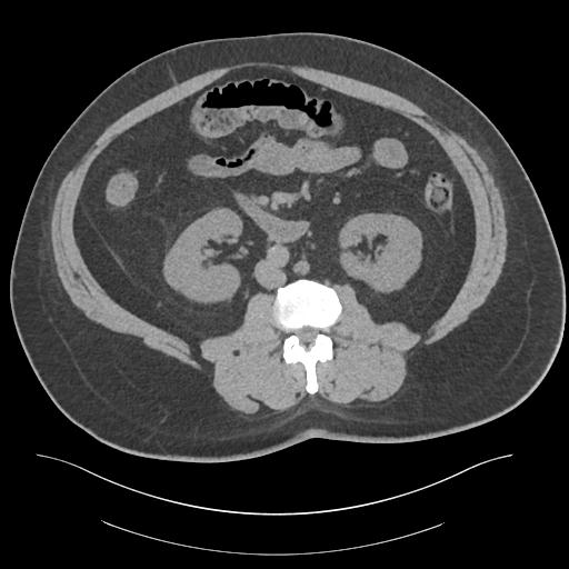 File:Adrenal vein sampling and adrenal nodular hyperplasia - Conn syndrome (Radiopaedia 30561-31337 Axial non-contrast 47).jpg