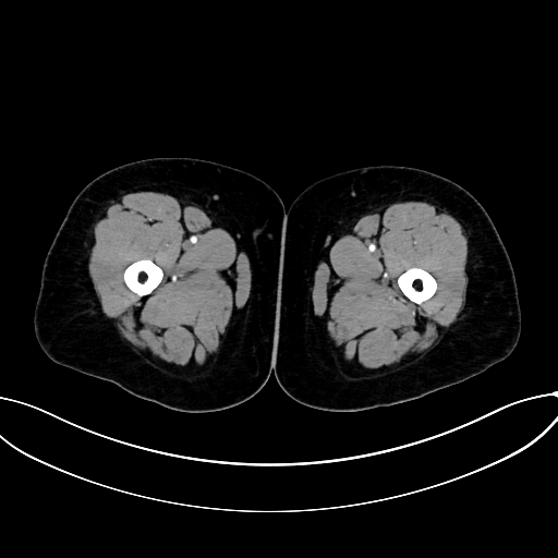 Adrenocortical carcinoma (Radiopaedia 87281-103569 Axial C+ arterial phase 108).jpg