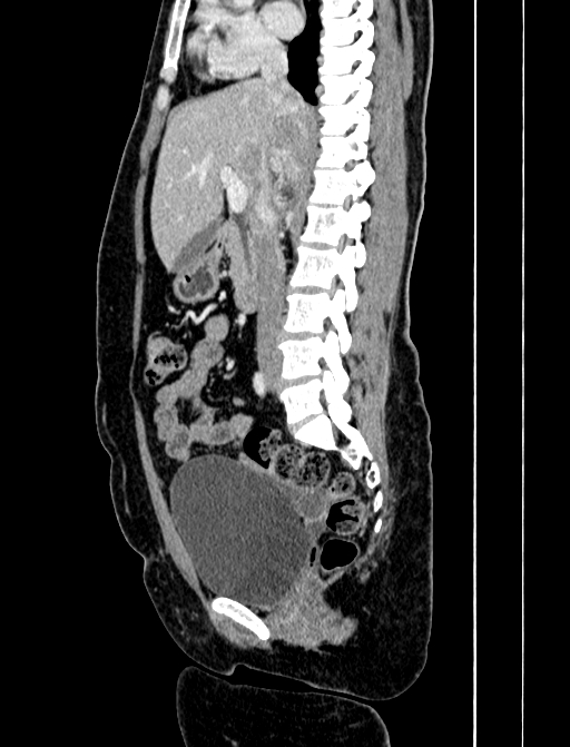 Adrenocortical carcinoma (Radiopaedia 87281-103569 Sagittal C+ portal venous phase 133).jpg