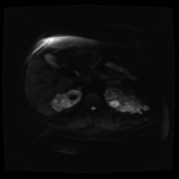 Adult polycystic kidney disease (Radiopaedia 59075-66365 Axial DWI 26).jpg