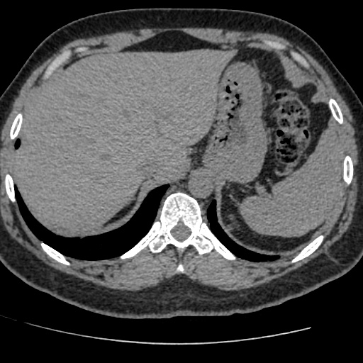 Adult polycystic kidney disease (Radiopaedia 59075-66368 Axial non-contrast 3).jpg