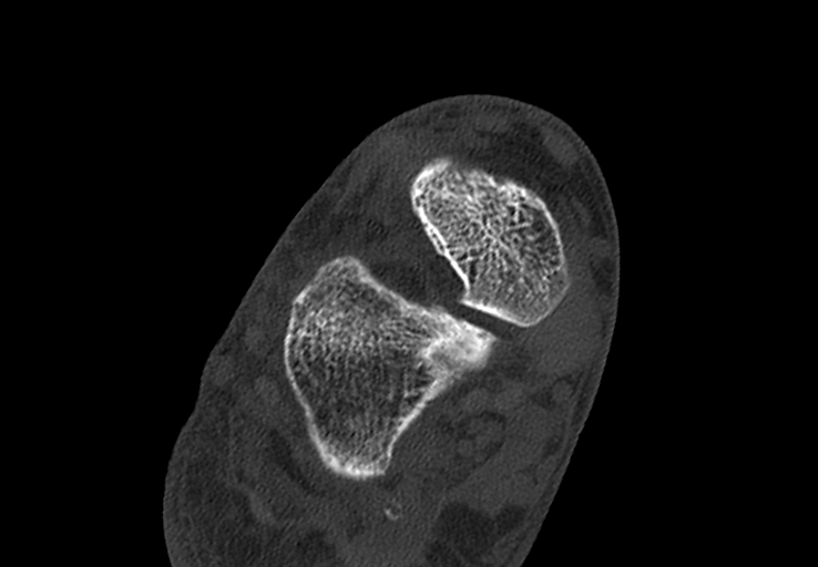 Advanced osteomyelitis due to open metatarsal fracture (Radiopaedia 83891-99095 Axial bone window 13).jpg
