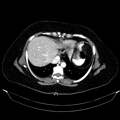 File:Afferent loop syndrome - secondary to incarcerated trocar site hernia (Radiopaedia 82959-97305 Axial C+ portal venous phase 26).jpg