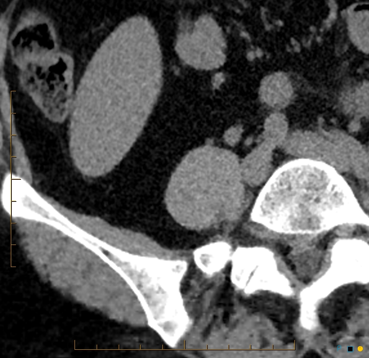Aggressive angiomyolipoma (Radiopaedia 55765-62328 Axial non-contrast 54).jpg