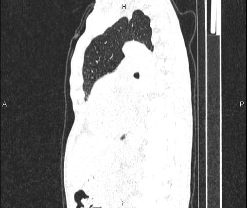 Air bronchogram in pneumonia (Radiopaedia 85719-101512 Sagittal lung window 58).jpg