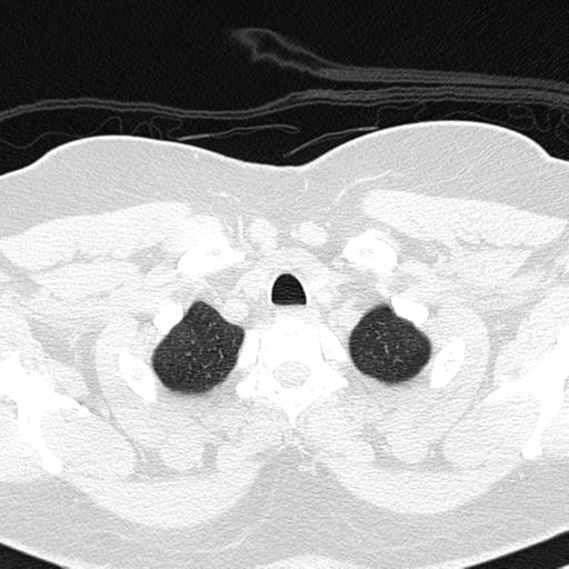 File:Air trapping in small airway disease (Radiopaedia 61685-69694 Axial lung window 13).jpg