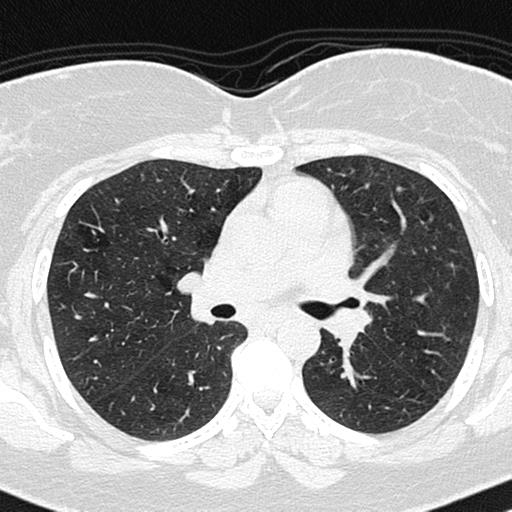 Air trapping in small airway disease (Radiopaedia 61685-69694 Axial lung window 77).jpg